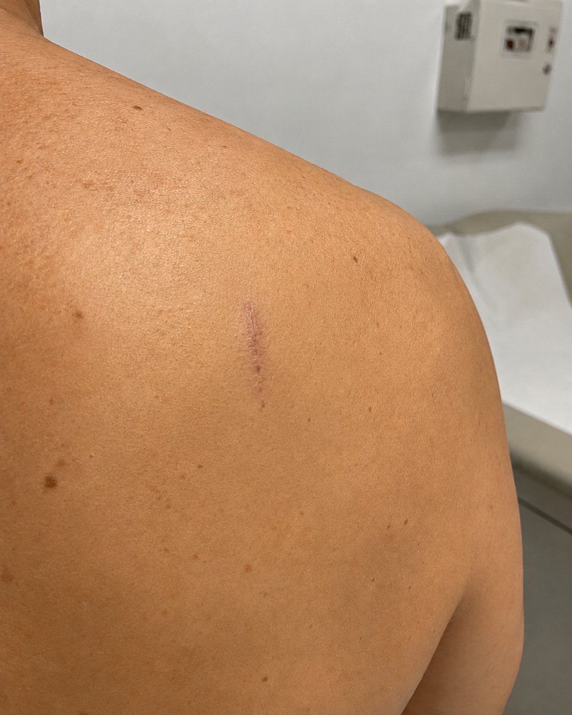 Illustration showing the same area of the upper back after lipoma removal, depicting the healed scar