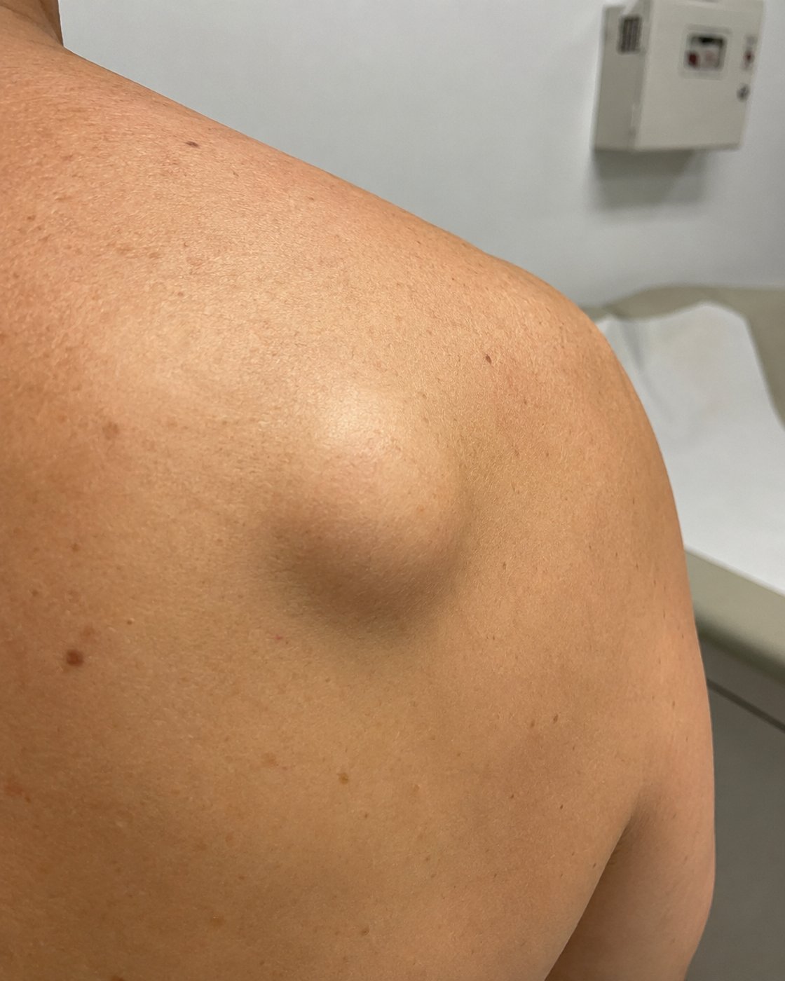 Illustration showing a lipoma on the upper back before removal, depicting a visible round soft-tissue bump